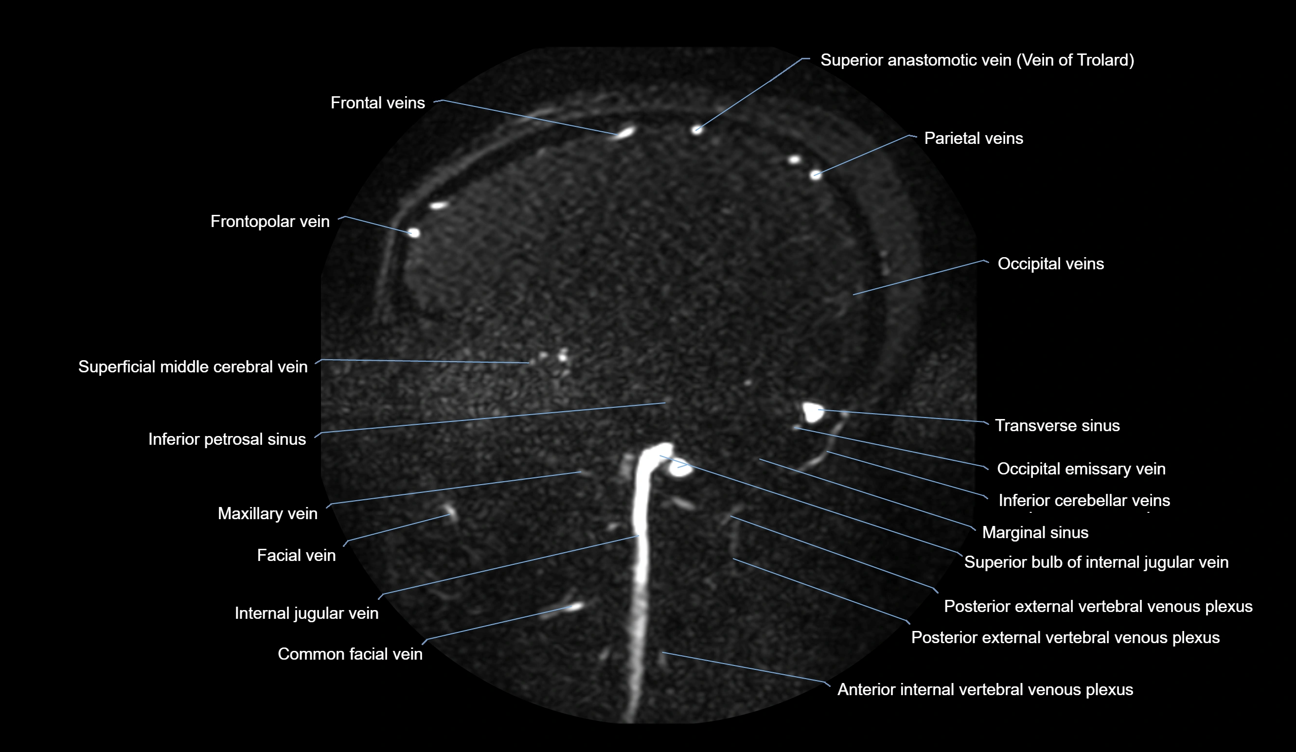 MRV brain sagittal anatomy 3T MRI labelledimages -00058.webp